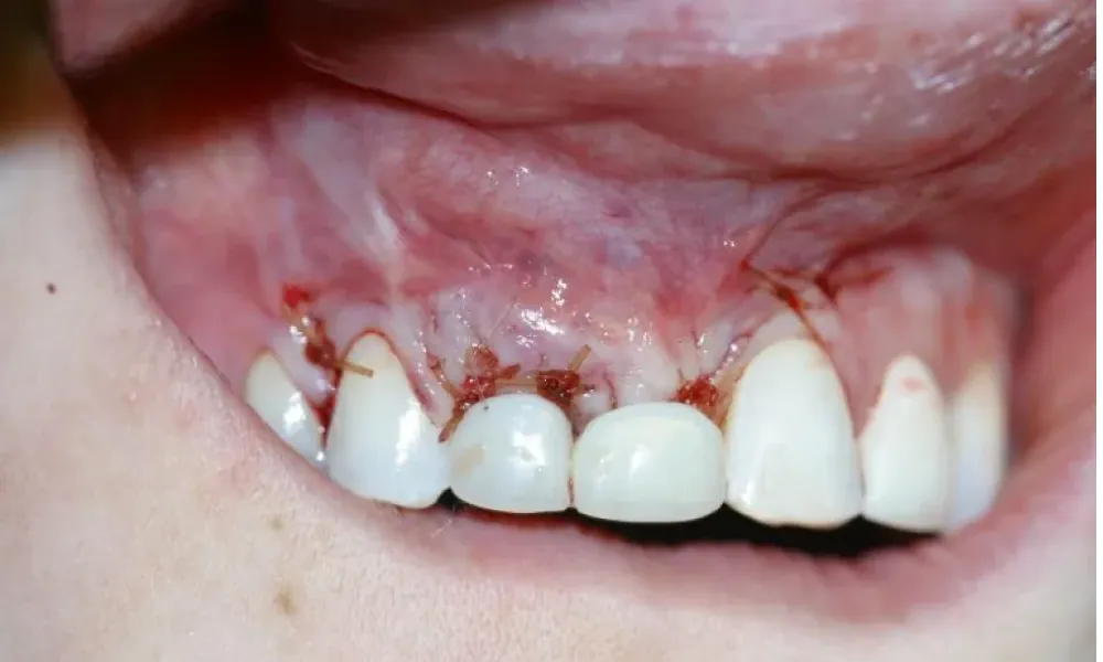 Clinical photo from Hope's smile reconstruction case